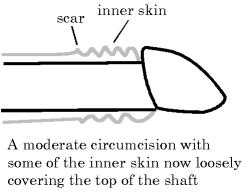 Moderate circumcision
